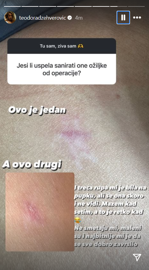 "Nisam savršena, imam nedostatke!" Teodora Džehverović nikad iskrenije o fizičkom izgledu, pa pokazala OŽILJKE od operacije (FOTO) 3 Screenshot 2024 03 14 131908