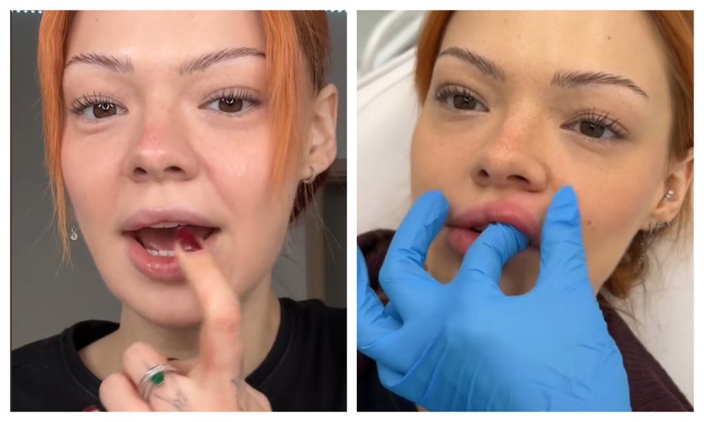 Vratila prirodan izgled: Popularna influenserka pokazala proces uklanjanja filera iz usana - evo kako sada izgleda! (VIDEO) 1 FotoJet6