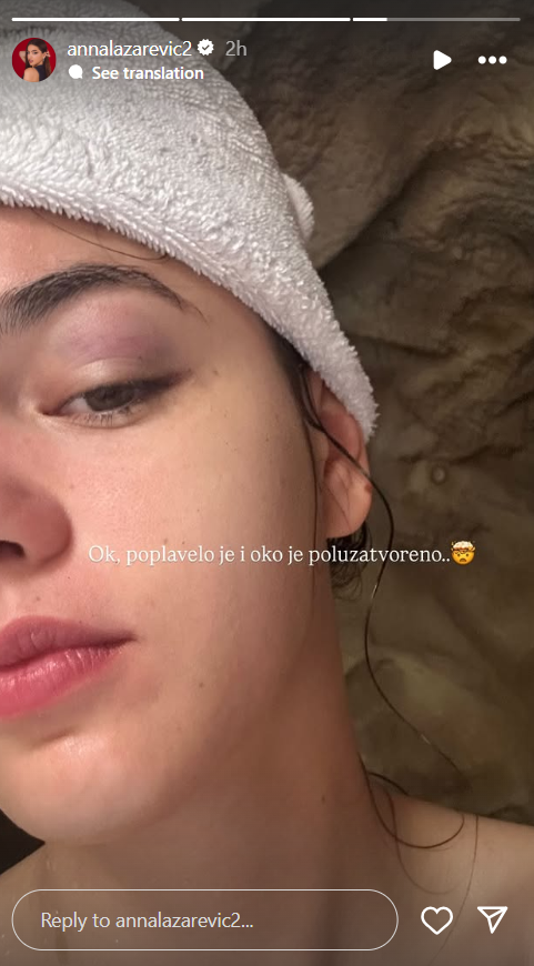 "Nisam videla zid i udarila sam se jako": Naša popularna influenserka doživela nezgodu na putovanju, pa otkrila sve o povredi (FOTO) 3 Screenshot 2025 05 27 092229